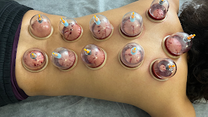 Hijama- Cupping Therapy place picture